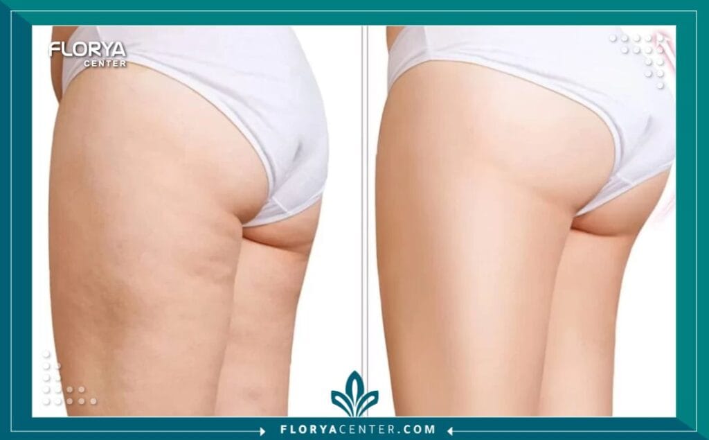 C2 1 - عمليات تجميل الأرداف والسيقان في تركيا هل تشعرين بأن عدم تناسق النصف السفلي من جسمك يقف حاجزاً أمام ثقتك بنفسك واختيارك للملابس التي تحبين؟ إن عمليات تجميل الأرداف والسيقان في تركيا (Lower Body Contouring) لم تعد مجرد رفاهية تجميلية، بل تحولت إلى حل جذري وفعال لاستعادة التوازن الجسدي والنفسي الذي طالما حلمتِ به. مع التطور الطبي الهائل، أصبح بإمكانك الآن نحت القوام بدقة متناهية، والتخلص من الترهلات العنيدة، والحصول على منحنيات أنثوية جذابة بأمان تام. تركيا اليوم ليست مجرد وجهة سياحية، بل هي عاصمة الطب التجميلي التي يقصدها الآلاف سنوياً لتحويل أحلامهم إلى واقع ملموس، مستفيدين من خبرات جراحية عالمية وتقنيات لا تتوفر بسهولة في أماكن أخرى.