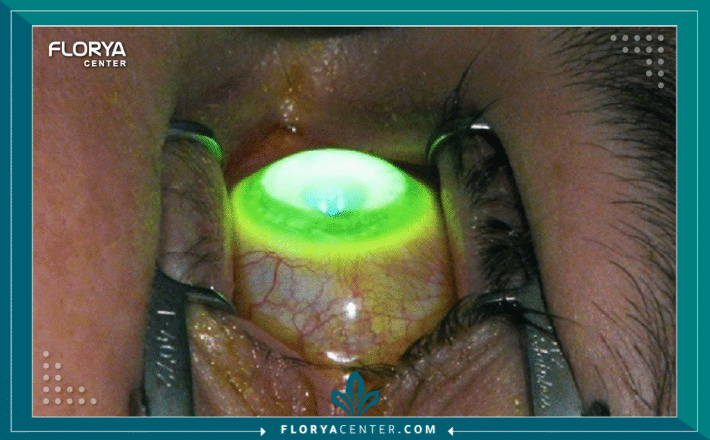 Copy of نسخة من Hayaalaje12 60 - معلومات عن تقوية القرنية (Corneal Cross-Linking) تُعد القرنية المخروطية (Keratoconus) من أكثر أمراض العيون التي تثير قلق المرضى نظراً لطبيعتها التقدمية التي تؤدي إلى ضعف النظر وتشتت الرؤية بشكل مستمر. في هذا السياق، يصبح البحث عن معلومات عن تقوية القرنية (Corneal Cross-Linking - CXL) هو الخطوة الأولى والحاسمة نحو الحفاظ على ما تبقى من حدة الإبصار ومنع الحاجة لزراعة القرنية مستقبلاً. إن هذه التقنية ليست مجرد إجراء تجميلي أو اختياري، بل هي علاج طبي وقائي يمثل المعيار الذهبي عالمياً لوقف انبعاج القرنية.