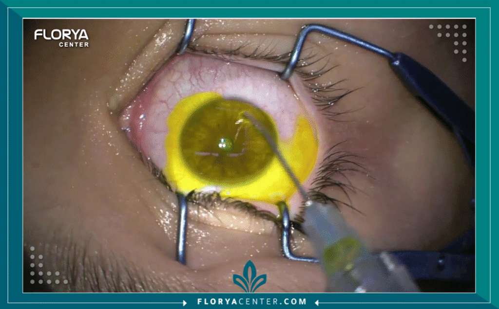 Copy of نسخة من Hayaalaje12 61 - معلومات عن تقوية القرنية (Corneal Cross-Linking) تُعد القرنية المخروطية (Keratoconus) من أكثر أمراض العيون التي تثير قلق المرضى نظراً لطبيعتها التقدمية التي تؤدي إلى ضعف النظر وتشتت الرؤية بشكل مستمر. في هذا السياق، يصبح البحث عن معلومات عن تقوية القرنية (Corneal Cross-Linking - CXL) هو الخطوة الأولى والحاسمة نحو الحفاظ على ما تبقى من حدة الإبصار ومنع الحاجة لزراعة القرنية مستقبلاً. إن هذه التقنية ليست مجرد إجراء تجميلي أو اختياري، بل هي علاج طبي وقائي يمثل المعيار الذهبي عالمياً لوقف انبعاج القرنية.