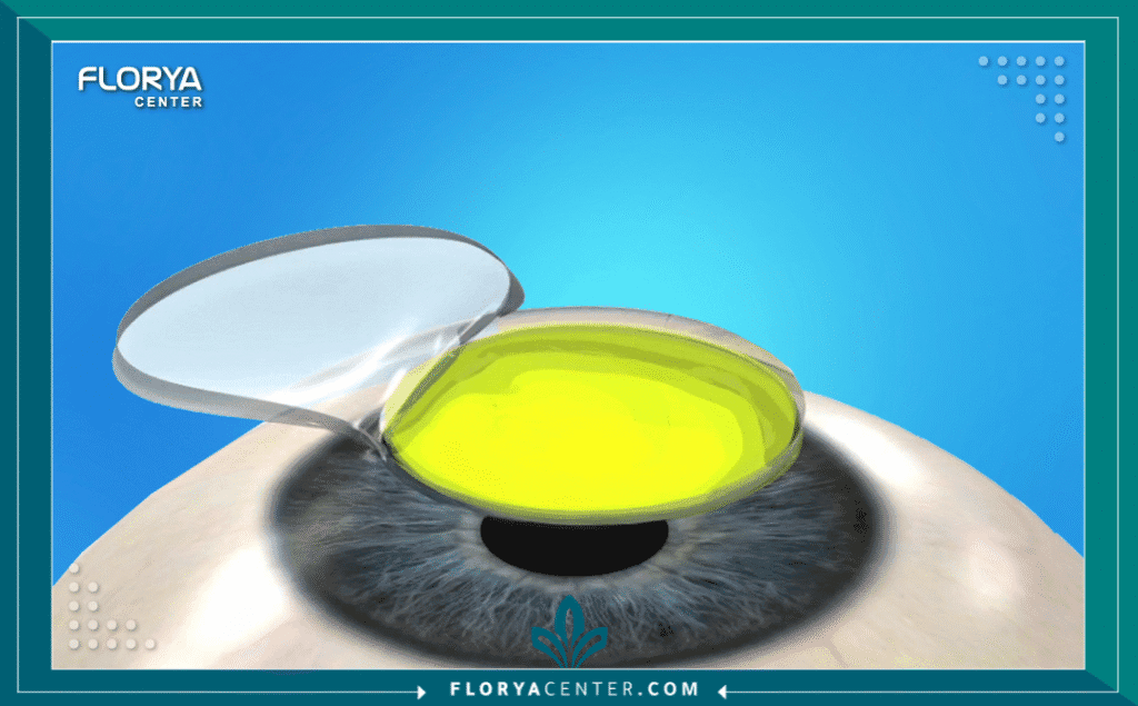 Copy of نسخة من Hayaalaje12 62 - معلومات عن تقوية القرنية (Corneal Cross-Linking) تُعد القرنية المخروطية (Keratoconus) من أكثر أمراض العيون التي تثير قلق المرضى نظراً لطبيعتها التقدمية التي تؤدي إلى ضعف النظر وتشتت الرؤية بشكل مستمر. في هذا السياق، يصبح البحث عن معلومات عن تقوية القرنية (Corneal Cross-Linking - CXL) هو الخطوة الأولى والحاسمة نحو الحفاظ على ما تبقى من حدة الإبصار ومنع الحاجة لزراعة القرنية مستقبلاً. إن هذه التقنية ليست مجرد إجراء تجميلي أو اختياري، بل هي علاج طبي وقائي يمثل المعيار الذهبي عالمياً لوقف انبعاج القرنية.