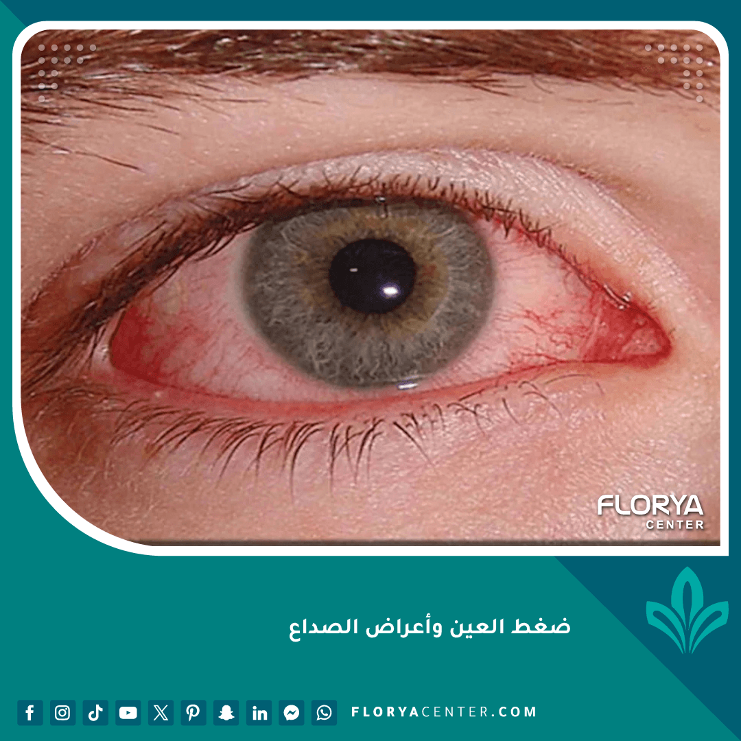 ضغط العين وأعراض الصداع