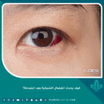 كيف يحدث انفصال الشبكية بعد الصدمة