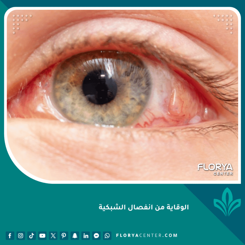 الوقاية من انفصال الشبكية