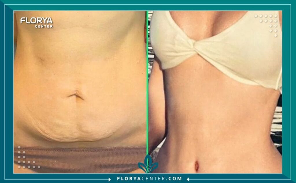 a1 2 - جراحة تجميل ما بعد فقدان الوزن اسطنبول هل حققت حلمك في الوصول إلى الوزن المثالي ولكنك شعرت بخيبة أمل بسبب ترهلات الجلد العنيدة التي تخفي إنجازك؟ إن جراحة تجميل ما بعد فقدان الوزن اسطنبول (Post-Weight Loss Surgery) ليست مجرد إجراء تجميلي لرفاهية المظهر، بل هي بوابتك الحقيقية لاستكمال رحلة التعافي واستعادة الوظائف الحيوية للجسم والثقة بالنفس. بعد رحلة شاقة من الحميات الغذائية القاسية أو جراحات السمنة (مثل التكميم وتحويل المسار)، يجد المريض نفسه محاصراً بجلد زائد لا يستجيب للرياضة، وهنا يأتي الدور الطبي الحاسم للجراحة التجميلية لتعيد رسم حدود الجسد وتمنحك القوام الذي طالما سعيت إليه. في تركيا، وتحديداً في مركز فلوريا، تحولت هذه الجراحات إلى فن طبي دقيق يجمع بين التكنولوجيا المتقدمة والخبرة الجراحية لضمان نتائج تغير مجرى الحياة.