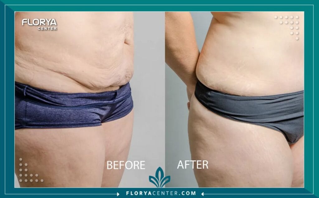 a2 1 - جراحة تجميل ما بعد فقدان الوزن اسطنبول هل حققت حلمك في الوصول إلى الوزن المثالي ولكنك شعرت بخيبة أمل بسبب ترهلات الجلد العنيدة التي تخفي إنجازك؟ إن جراحة تجميل ما بعد فقدان الوزن اسطنبول (Post-Weight Loss Surgery) ليست مجرد إجراء تجميلي لرفاهية المظهر، بل هي بوابتك الحقيقية لاستكمال رحلة التعافي واستعادة الوظائف الحيوية للجسم والثقة بالنفس. بعد رحلة شاقة من الحميات الغذائية القاسية أو جراحات السمنة (مثل التكميم وتحويل المسار)، يجد المريض نفسه محاصراً بجلد زائد لا يستجيب للرياضة، وهنا يأتي الدور الطبي الحاسم للجراحة التجميلية لتعيد رسم حدود الجسد وتمنحك القوام الذي طالما سعيت إليه. في تركيا، وتحديداً في مركز فلوريا، تحولت هذه الجراحات إلى فن طبي دقيق يجمع بين التكنولوجيا المتقدمة والخبرة الجراحية لضمان نتائج تغير مجرى الحياة.