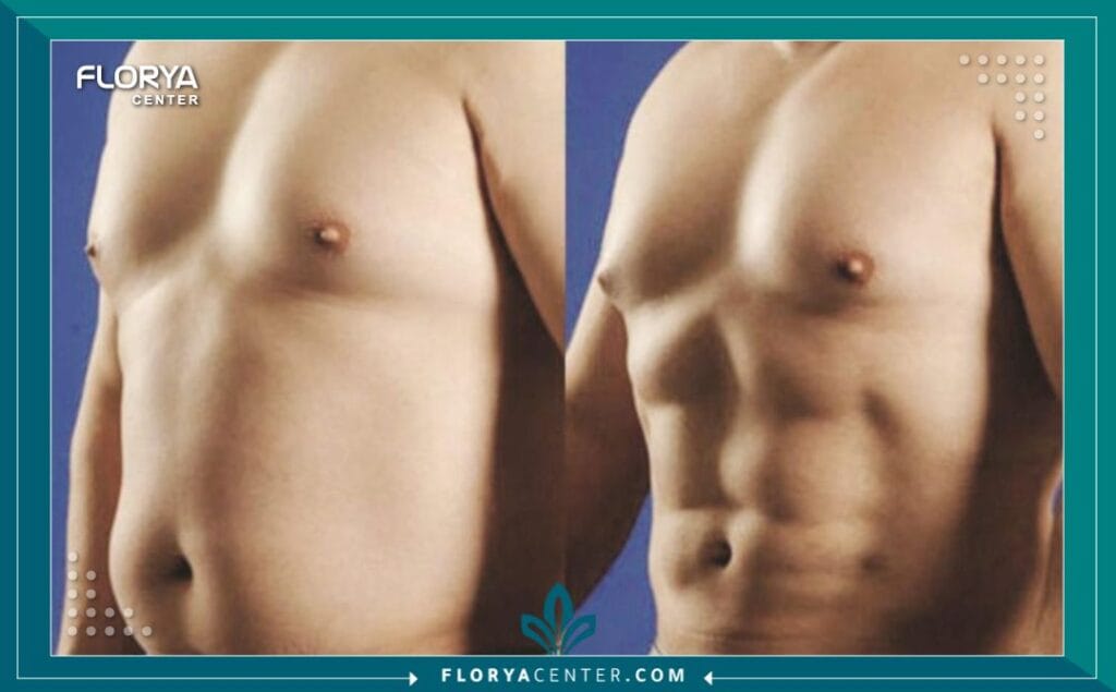 a3 1 - جراحة تجميل ما بعد فقدان الوزن اسطنبول هل حققت حلمك في الوصول إلى الوزن المثالي ولكنك شعرت بخيبة أمل بسبب ترهلات الجلد العنيدة التي تخفي إنجازك؟ إن جراحة تجميل ما بعد فقدان الوزن اسطنبول (Post-Weight Loss Surgery) ليست مجرد إجراء تجميلي لرفاهية المظهر، بل هي بوابتك الحقيقية لاستكمال رحلة التعافي واستعادة الوظائف الحيوية للجسم والثقة بالنفس. بعد رحلة شاقة من الحميات الغذائية القاسية أو جراحات السمنة (مثل التكميم وتحويل المسار)، يجد المريض نفسه محاصراً بجلد زائد لا يستجيب للرياضة، وهنا يأتي الدور الطبي الحاسم للجراحة التجميلية لتعيد رسم حدود الجسد وتمنحك القوام الذي طالما سعيت إليه. في تركيا، وتحديداً في مركز فلوريا، تحولت هذه الجراحات إلى فن طبي دقيق يجمع بين التكنولوجيا المتقدمة والخبرة الجراحية لضمان نتائج تغير مجرى الحياة.