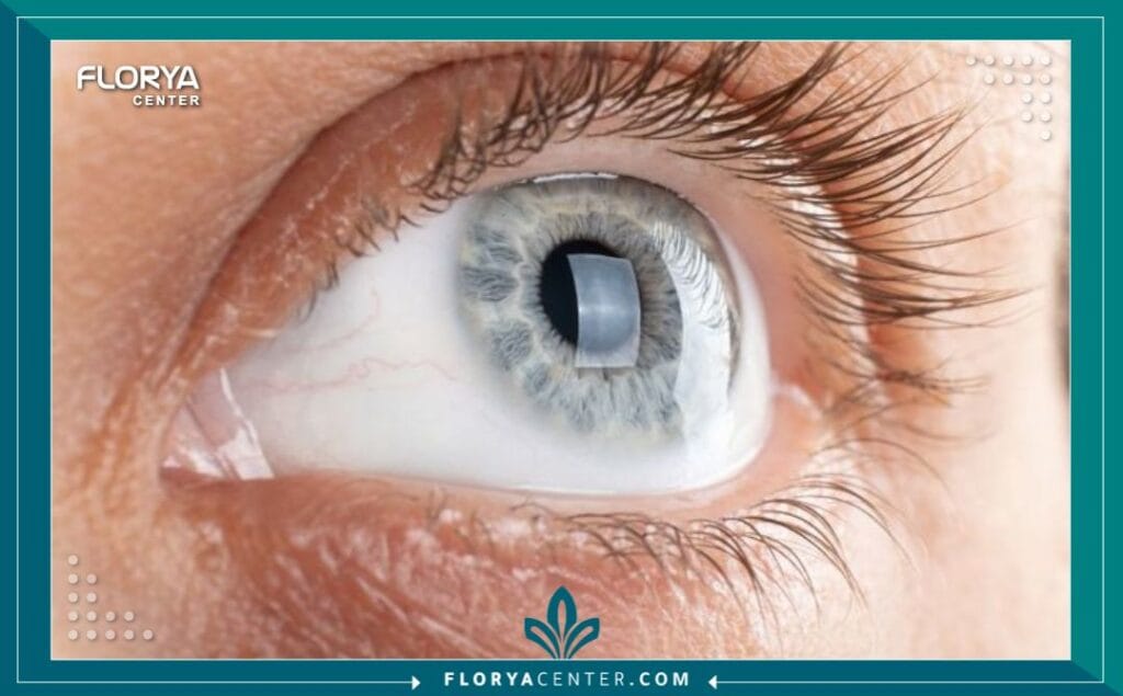 a3 15 - دكتور عيون لعلاج القرنية المخروطية في تركيا عندما يتعلق الأمر بـ "القرنية المخروطية"، فإن البحث عن أفضل دكتور عيون لعلاج القرنية المخروطية في تركيا ليس مجرد خيار طبي، بل هو قرار حاسم لإنقاذ البصر. هذا المرض، الذي يتسبب في ترقق القرنية وتحولها التدريجي إلى شكل مخروطي، يمكن أن يهدد جودة الحياة بشكل كبير إذا لم يُعالج بالشكل الصحيح. تركيا، وخاصة اسطنبول، برزت كمركز عالمي رائد في طب العيون، حيث تجمع بين الخبرات الطبية الفائقة وأحدث التقنيات التشخيصية والعلاجية.