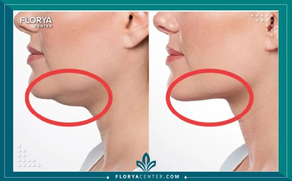 a4 - تكلفة تجميل الذقن المزدوج في اسطنبول هل تساءلت يوماً عن تفاصيل وتحديثات عام 2026 المتعلقة بمعرفة تكلفة تجميل الذقن المزدوج في اسطنبول (Double Chin Removal Cost) وكيف يمكن لهذا الإجراء أن يغير ملامح وجهك جذرياً؟ إن البحث عن الجمال وتناسق الملامح لم يعد رفاهية، بل استثماراً حقيقياً في الثقة بالنفس، خاصة عند الحديث عن التخلص من الدهون المتراكمة أسفل الذقن التي تخفي تقاسيم الوجه الحقيقية، ولا سيما عند الرجال حيث يتطلب الأمر نحتاً دقيقاً للحفاظ على الهوية الذكورية (Masculinity) وإبراز عظمة الفك بوضوح. إن هذا الدليل ليس مجرد سرد للأرقام، بل هو خارطة طريق تضمن لك استثماراً آمناً ونتيجة تجميلية تضاهي المعايير العالمية، حيث سنغوص في أعماق التفاصيل المالية والطبية لنقدم لك الصورة الكاملة بكل شفافية.