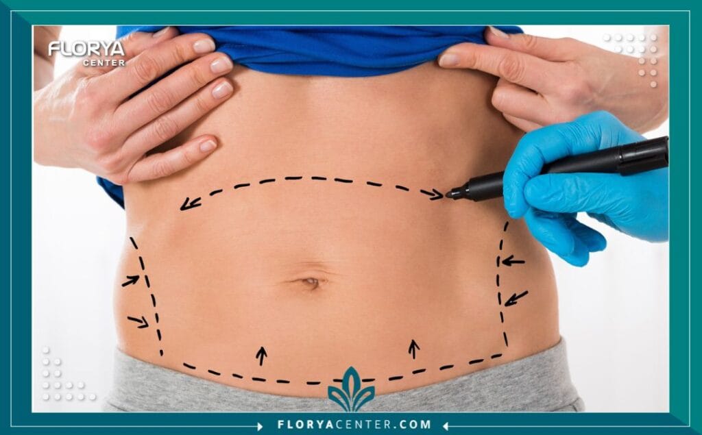 a5 1 - جراحة تجميل ما بعد فقدان الوزن اسطنبول هل حققت حلمك في الوصول إلى الوزن المثالي ولكنك شعرت بخيبة أمل بسبب ترهلات الجلد العنيدة التي تخفي إنجازك؟ إن جراحة تجميل ما بعد فقدان الوزن اسطنبول (Post-Weight Loss Surgery) ليست مجرد إجراء تجميلي لرفاهية المظهر، بل هي بوابتك الحقيقية لاستكمال رحلة التعافي واستعادة الوظائف الحيوية للجسم والثقة بالنفس. بعد رحلة شاقة من الحميات الغذائية القاسية أو جراحات السمنة (مثل التكميم وتحويل المسار)، يجد المريض نفسه محاصراً بجلد زائد لا يستجيب للرياضة، وهنا يأتي الدور الطبي الحاسم للجراحة التجميلية لتعيد رسم حدود الجسد وتمنحك القوام الذي طالما سعيت إليه. في تركيا، وتحديداً في مركز فلوريا، تحولت هذه الجراحات إلى فن طبي دقيق يجمع بين التكنولوجيا المتقدمة والخبرة الجراحية لضمان نتائج تغير مجرى الحياة.
