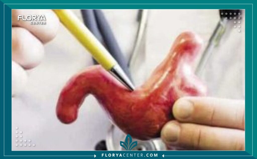 aa3 2 - جراحة تصغير المعدة في اسطنبول هل تشعر بأن السمنة تسرق أجمل سنوات عمرك وتُقيدك بقيود صحية ونفسية لا تنتهي؟ إن جراحة تصغير المعدة في اسطنبول (Gastric Reduction Surgery) ليست مجرد إجراء تجميلي لإنقاص الوزن، بل هي بوابتك للزمن الجميل واستعادة السيطرة الكاملة على صحتك وحياتك من جديد. في ظل تزايد معدلات السمنة عالمياً، برزت إسطنبول كعاصمة عالمية للسياحة العلاجية، حيث توفر حلولاً جذرية تجمع بين الخبرة الطبية العالية والتكلفة المدروسة. إن اتخاذ قرار الخضوع لـ جراحة تصغير المعدة في اسطنبول هو خطوة شجاعة نحو التخلص من الأمراض المزمنة مثل السكري وارتفاع ضغط الدم، وبداية رحلة تحول حقيقي تعيد لك ثقتك بنفسك.