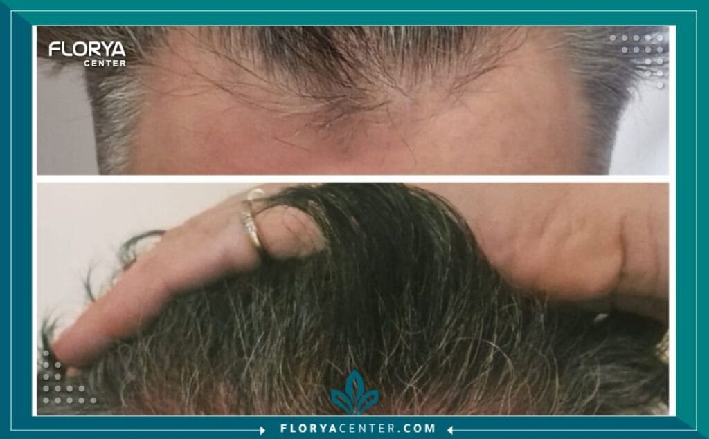 b1 8 - دكتور زراعة شعر بتقنية DHI في اسطنبول عندما يتعلق الأمر باستعادة الثقة والحصول على مظهر شعر طبيعي وكثيف، تبرز تقنية DHI (زراعة الشعر المباشر) كحل ذهبي في عالم التجميل. لكن نجاح هذا الإجراء الدقيق لا يعتمد على التقنية وحدها، بل يعتمد بشكل أساسي على مهارة وخبرة من يطبقها. لذلك، فإن رحلة البحث عن أفضل دكتور زراعة شعر بتقنية DHI في اسطنبول هي الخطوة الأهم والأكثر حسماً في مسار علاجك.