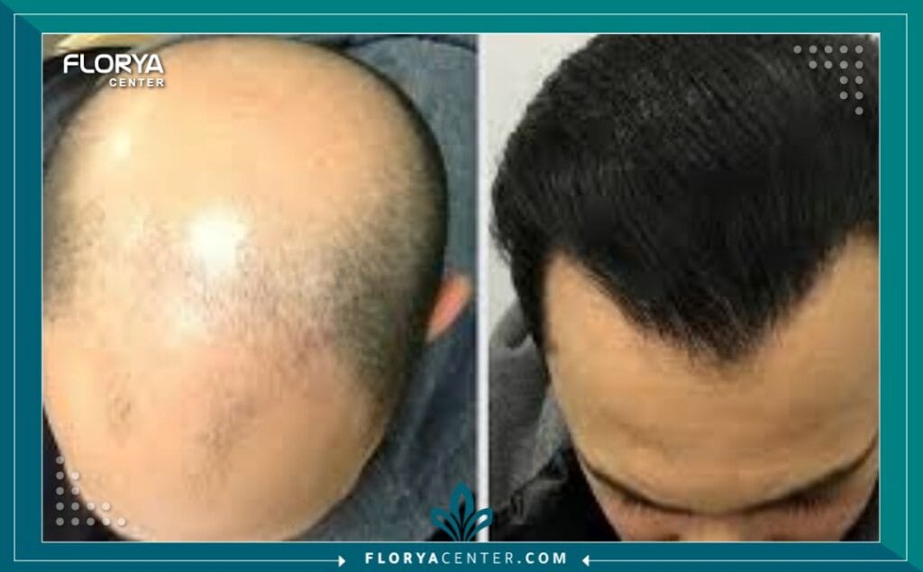 b2 8 - دكتور زراعة شعر بتقنية DHI في اسطنبول عندما يتعلق الأمر باستعادة الثقة والحصول على مظهر شعر طبيعي وكثيف، تبرز تقنية DHI (زراعة الشعر المباشر) كحل ذهبي في عالم التجميل. لكن نجاح هذا الإجراء الدقيق لا يعتمد على التقنية وحدها، بل يعتمد بشكل أساسي على مهارة وخبرة من يطبقها. لذلك، فإن رحلة البحث عن أفضل دكتور زراعة شعر بتقنية DHI في اسطنبول هي الخطوة الأهم والأكثر حسماً في مسار علاجك.
