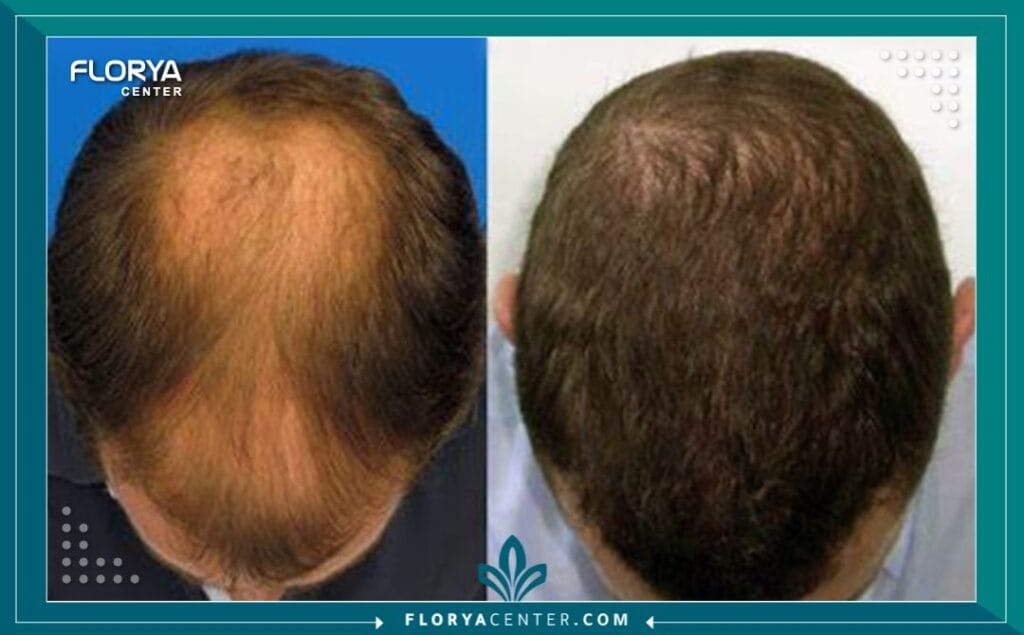 b4 7 - دكتور زراعة شعر بتقنية DHI في اسطنبول عندما يتعلق الأمر باستعادة الثقة والحصول على مظهر شعر طبيعي وكثيف، تبرز تقنية DHI (زراعة الشعر المباشر) كحل ذهبي في عالم التجميل. لكن نجاح هذا الإجراء الدقيق لا يعتمد على التقنية وحدها، بل يعتمد بشكل أساسي على مهارة وخبرة من يطبقها. لذلك، فإن رحلة البحث عن أفضل دكتور زراعة شعر بتقنية DHI في اسطنبول هي الخطوة الأهم والأكثر حسماً في مسار علاجك.