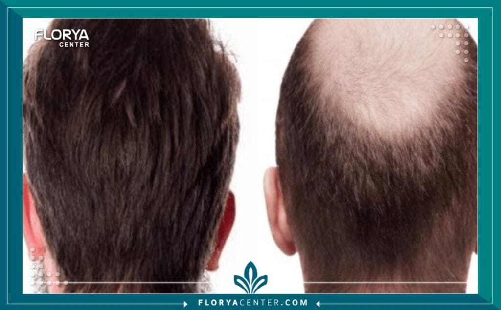 c1 5 - أرخص زراعة شعر في اسطنبول (مع الجودة) هل نظرت يوماً في المرآة وشعرت أن العمر يسرق ملامحك قبل الأوان؟ إن البحث عن أرخص زراعة شعر في اسطنبول (The Cheapest Hair Transplant in Istanbul) ليس مجرد رحلة لتوفير المال، بل هو قرار استراتيجي لاستعادة "النسخة الأفضل" من نفسك بأذكى الطرق الاقتصادية. في عالم اليوم، لم يعد الصلع حكماً مؤبداً، بل حالة طبية قابلة للعلاج الجذري، وتُعد إسطنبول الوجهة العالمية الأولى التي نجحت في تحويل هذا الحلم إلى حقيقة ملموسة لملايين الرجال والنساء.