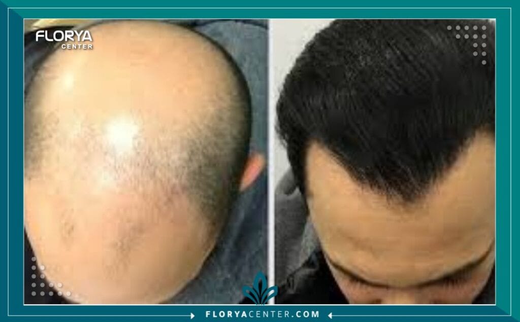 c2 6 - أرخص زراعة شعر في اسطنبول (مع الجودة) هل نظرت يوماً في المرآة وشعرت أن العمر يسرق ملامحك قبل الأوان؟ إن البحث عن أرخص زراعة شعر في اسطنبول (The Cheapest Hair Transplant in Istanbul) ليس مجرد رحلة لتوفير المال، بل هو قرار استراتيجي لاستعادة "النسخة الأفضل" من نفسك بأذكى الطرق الاقتصادية. في عالم اليوم، لم يعد الصلع حكماً مؤبداً، بل حالة طبية قابلة للعلاج الجذري، وتُعد إسطنبول الوجهة العالمية الأولى التي نجحت في تحويل هذا الحلم إلى حقيقة ملموسة لملايين الرجال والنساء.