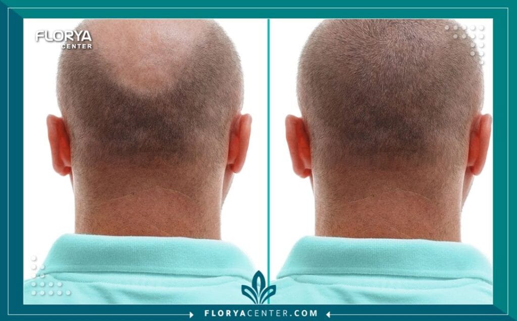 c3 5 - أرخص زراعة شعر في اسطنبول (مع الجودة) هل نظرت يوماً في المرآة وشعرت أن العمر يسرق ملامحك قبل الأوان؟ إن البحث عن أرخص زراعة شعر في اسطنبول (The Cheapest Hair Transplant in Istanbul) ليس مجرد رحلة لتوفير المال، بل هو قرار استراتيجي لاستعادة "النسخة الأفضل" من نفسك بأذكى الطرق الاقتصادية. في عالم اليوم، لم يعد الصلع حكماً مؤبداً، بل حالة طبية قابلة للعلاج الجذري، وتُعد إسطنبول الوجهة العالمية الأولى التي نجحت في تحويل هذا الحلم إلى حقيقة ملموسة لملايين الرجال والنساء.