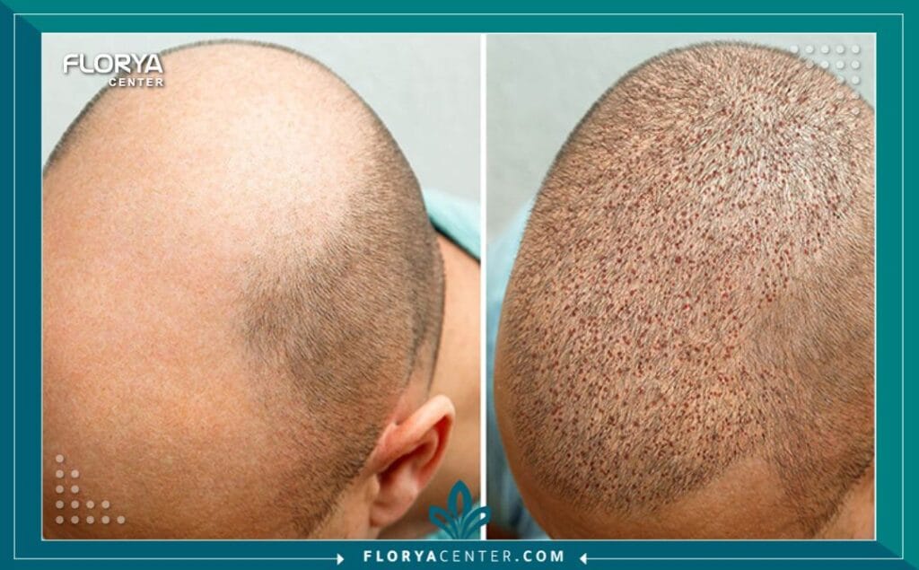 c4 5 - أرخص زراعة شعر في اسطنبول (مع الجودة) هل نظرت يوماً في المرآة وشعرت أن العمر يسرق ملامحك قبل الأوان؟ إن البحث عن أرخص زراعة شعر في اسطنبول (The Cheapest Hair Transplant in Istanbul) ليس مجرد رحلة لتوفير المال، بل هو قرار استراتيجي لاستعادة "النسخة الأفضل" من نفسك بأذكى الطرق الاقتصادية. في عالم اليوم، لم يعد الصلع حكماً مؤبداً، بل حالة طبية قابلة للعلاج الجذري، وتُعد إسطنبول الوجهة العالمية الأولى التي نجحت في تحويل هذا الحلم إلى حقيقة ملموسة لملايين الرجال والنساء.