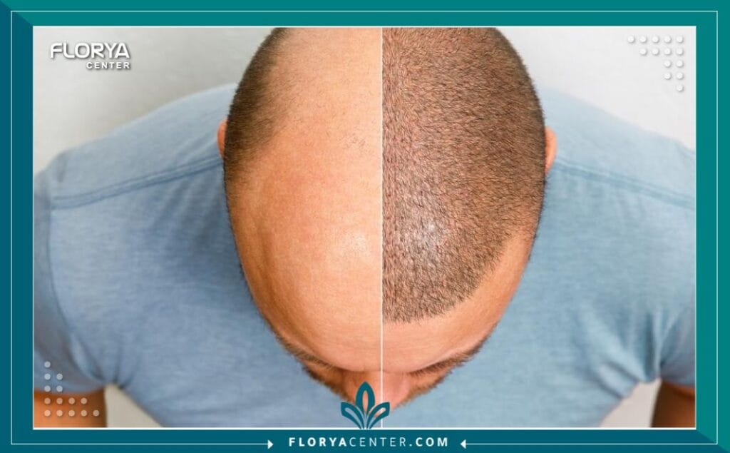 c5 3 - أرخص زراعة شعر في اسطنبول (مع الجودة) هل نظرت يوماً في المرآة وشعرت أن العمر يسرق ملامحك قبل الأوان؟ إن البحث عن أرخص زراعة شعر في اسطنبول (The Cheapest Hair Transplant in Istanbul) ليس مجرد رحلة لتوفير المال، بل هو قرار استراتيجي لاستعادة "النسخة الأفضل" من نفسك بأذكى الطرق الاقتصادية. في عالم اليوم، لم يعد الصلع حكماً مؤبداً، بل حالة طبية قابلة للعلاج الجذري، وتُعد إسطنبول الوجهة العالمية الأولى التي نجحت في تحويل هذا الحلم إلى حقيقة ملموسة لملايين الرجال والنساء.