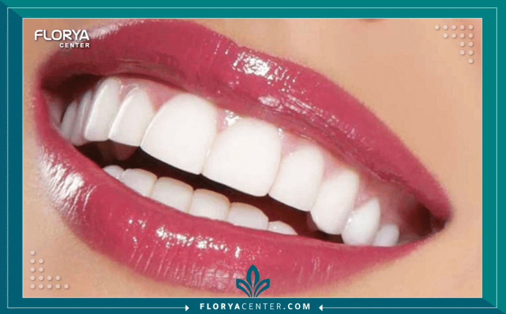 تكلفة ابتسامة هوليود 2 nouralagee93@gmail.com 20250801 154303 ٠٠٠٠ - تكلفة ابتسامة هوليود هل تخيلت يوماً أن يكون مفتاح ثقتك بنفسك وجواز عبورك لقلوب الآخرين مجرد ابتسامة؟ ابتسامتك هي بطاقة تعريفك الأولى، وفي عالم اليوم، لم يعد الحصول على تلك "الابتسامة السينمائية" حلماً بعيد المنال، بل قراراً استثمارياً ذكياً. عندما تبحث عن تكلفة ابتسامة هوليود (Hollywood Smile Cost)، فأنت لا تبحث فقط عن سعر، بل تبحث عن جودة حياة جديدة، وثقة لا تتزعزع، ومظهر يسرق الأضواء. في هذا الدليل، نضع بين يديك الحقيقة الكاملة والأرقام الدقيقة لعام 2026، لننتقل بك من الحيرة إلى اليقين، مع شريكك الموثوق في رحلة الجمال، "مركز فلوريا".