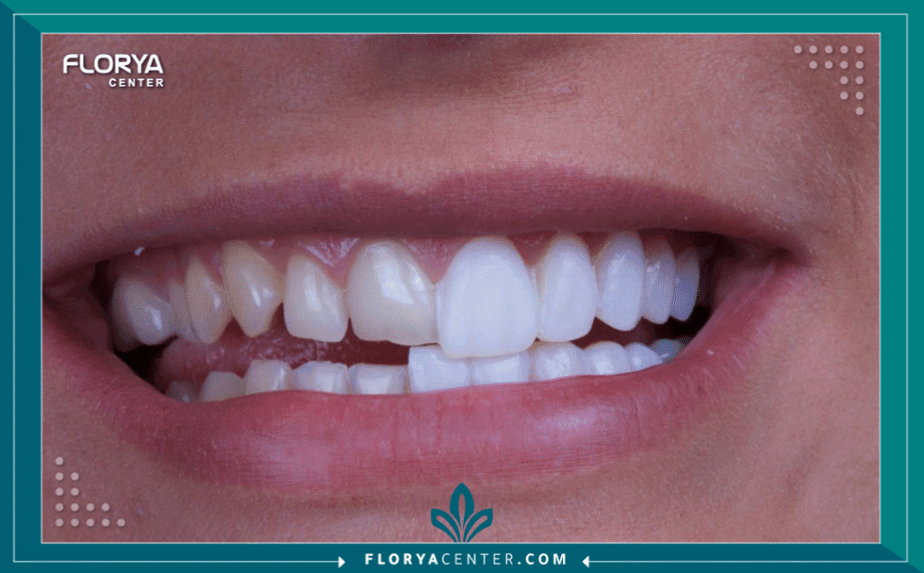 nouralagee93@gmail.com 20250802 095931 ٠٠٠٠ 2 - أنواع عدسات الأسنان (فينير ولومينير) تعتبر أنواع عدسات الأسنان (فينير ولومينير) اليوم واحدة من أكثر الإجراءات طلباً في عالم طب الأسنان التجميلي، فهي تمثل الحل السحري للحصول على "ابتسامة هوليوود" البيضاء والمتناسقة. لم يعد الأمر يقتصر على المشاهير، بل أصبح خياراً متاحاً لكل من يبحث عن تحسين جذري وسريع لمظهر أسنانه. سواء كنت تعاني من تصبغات عميقة، أو كسور بسيطة، أو فراغات لا ترغب بها، فإن عدسات الأسنان (Dental Veneers) تقدم حلاً فعالاً.