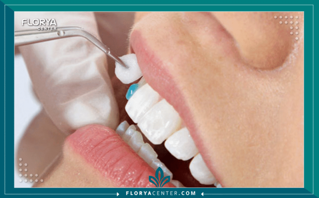 nouralagee93@gmail.com 20250802 095947 ٠٠٠٠ - أنواع عدسات الأسنان (فينير ولومينير) تعتبر أنواع عدسات الأسنان (فينير ولومينير) اليوم واحدة من أكثر الإجراءات طلباً في عالم طب الأسنان التجميلي، فهي تمثل الحل السحري للحصول على "ابتسامة هوليوود" البيضاء والمتناسقة. لم يعد الأمر يقتصر على المشاهير، بل أصبح خياراً متاحاً لكل من يبحث عن تحسين جذري وسريع لمظهر أسنانه. سواء كنت تعاني من تصبغات عميقة، أو كسور بسيطة، أو فراغات لا ترغب بها، فإن عدسات الأسنان (Dental Veneers) تقدم حلاً فعالاً.