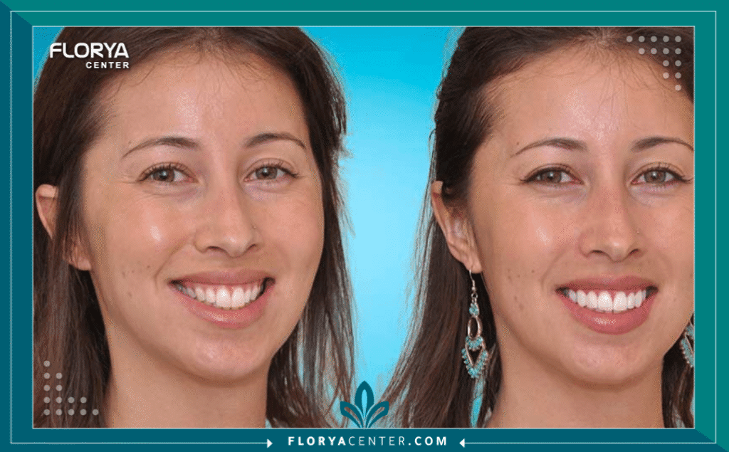 nouralagee93@gmail.com 20250804 111306 ٠٠٠٠ - طرق تجميل الأسنان الكبيرة تُعد طرق تجميل الأسنان الكبيرة (Cosmetic Tooth Reshaping) من أكثر الإجراءات التجميلية طلباً في طب الأسنان الحديث، حيث يسعى الكثيرون للحصول على ابتسامة متوازنة ومتناسقة مع ملامح الوجه. إن وجود أسنان تبدو "كبيرة" بشكل غير متناسب، سواء كان ذلك بسبب الحجم الفعلي للسن أو بسبب عوامل أخرى مثل خط اللثة، يمكن أن يؤثر على الثقة بالنفس. من الضروري طبياً التمييز بين المظهر الجمالي للأسنان الكبيرة والحالة الطبية المعروفة باسم "الماكرودونتيا" (Macrodontia)، والتي قد تتطلب نهجاً علاجياً مختلفاً.