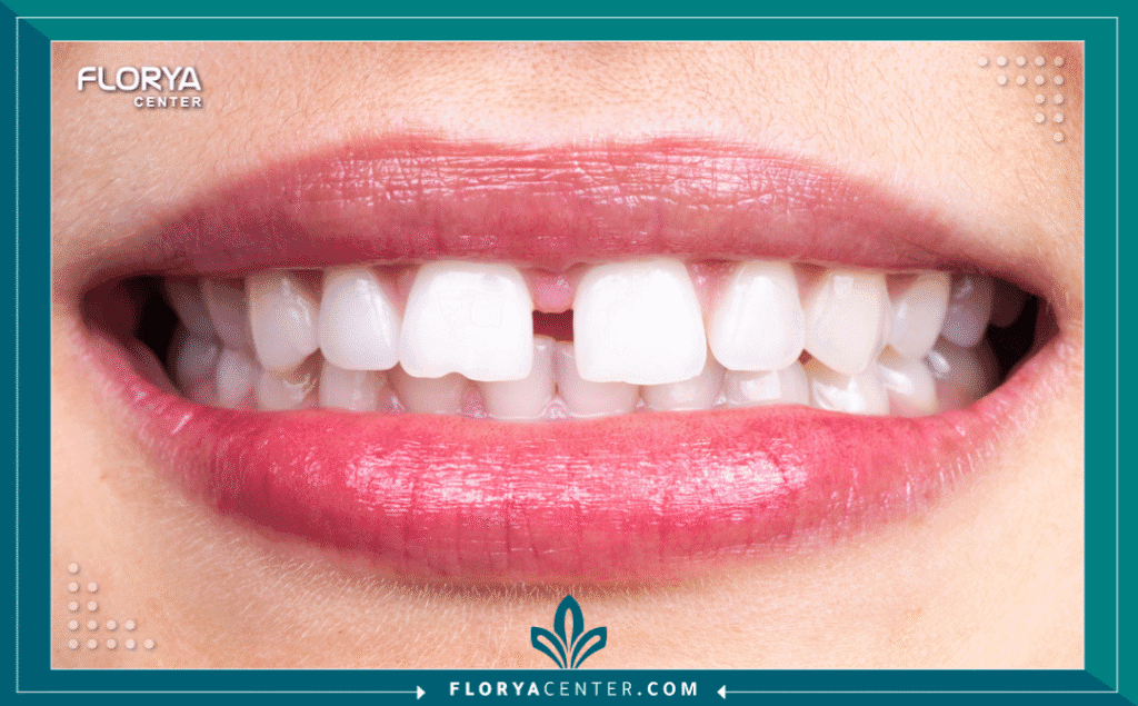 nouralagee93@gmail.com 20250804 124811 ٠٠٠٠ - تجميل الأسنان المتفرقة (الفلجة) يُعد تجميل الأسنان المتفرقة (الفلجة) من أكثر الإجراءات طلباً في طب الأسنان الحديث، حيث لا يقتصر الهدف منه على التحسين الجمالي فحسب، بل يمتد ليشمل تصحيح وظائف الفم والحفاظ على صحة اللثة. الفلجة، أو ما يعرف طبياً بـ (Diastema)، هي مسافة أو فجوة تزيد عن 0.5 ملم بين سنين متجاورتين، وغالباً ما تظهر بين القواطع العلوية الأمامية (Maxillary Central Incisors). تشير الدراسات المنشورة في Journal of the American Dental Association إلى أن تجميل الأسنان المتفرقة يتطلب تشخيصاً دقيقاً لمعرفة السبب الجذري، سواء كان وراثياً، أو ناتجاً عن صغر حجم الأسنان مقارنة بالفك، أو بسبب لجام الشفة (Labial Frenum) المرتفع.