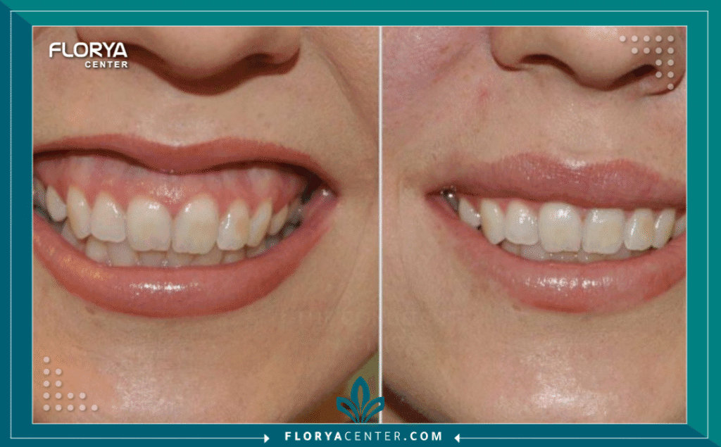 nouralagee93@gmail.com 20250805 204727 ٠٠٠٠ - تجميل اللثة بالليزر يُعد تجميل اللثة بالليزر (Laser Gum Contouring) ثورة حقيقية في عالم طب الأسنان التجميلي، مقدماً حلاً فائق الدقة لأولئك الذين يشعرون بالخجل من "الابتسامة اللثوية" (Gummy Smile) أو عدم تناسق خط اللثة. إذا كنت تشعر أن لثتك تظهر بشكل مبالغ فيه عند الابتسام، أو أن أسنانك تبدو أقصر مما هي عليه، فإن هذا الإجراء البسيط والدقيق قد يكون المفتاح لتحرير ابتسامتك الكاملة. في الماضي، كانت الجراحة التقليدية هي الخيار الوحيد، وغالباً ما كانت مصحوبة بفترة تعافٍ طويلة. اليوم، يتيح تجميل اللثة بالليزر نحت خط اللثة المثالي بأقل قدر من التدخل، وبدقة متناهية، وبدون ألم تقريباً. يقدم "مركز فلوريا" في تركيا هذا الإجراء المتقدم، معتمداً على أحدث التقنيات لضمان نتائج فورية ومبهرة، مع التزام كامل براحة المريض وسلامته.