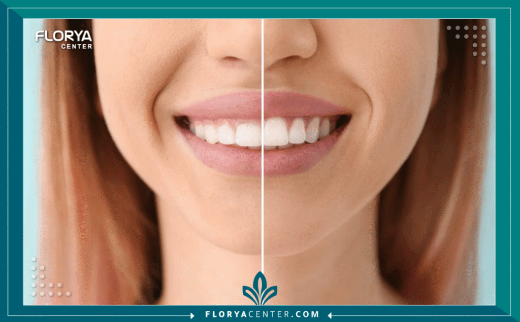 nouralagee93@gmail.com 20250805 204826 ٠٠٠٠ - تجميل اللثة بالليزر يُعد تجميل اللثة بالليزر (Laser Gum Contouring) ثورة حقيقية في عالم طب الأسنان التجميلي، مقدماً حلاً فائق الدقة لأولئك الذين يشعرون بالخجل من "الابتسامة اللثوية" (Gummy Smile) أو عدم تناسق خط اللثة. إذا كنت تشعر أن لثتك تظهر بشكل مبالغ فيه عند الابتسام، أو أن أسنانك تبدو أقصر مما هي عليه، فإن هذا الإجراء البسيط والدقيق قد يكون المفتاح لتحرير ابتسامتك الكاملة. في الماضي، كانت الجراحة التقليدية هي الخيار الوحيد، وغالباً ما كانت مصحوبة بفترة تعافٍ طويلة. اليوم، يتيح تجميل اللثة بالليزر نحت خط اللثة المثالي بأقل قدر من التدخل، وبدقة متناهية، وبدون ألم تقريباً. يقدم "مركز فلوريا" في تركيا هذا الإجراء المتقدم، معتمداً على أحدث التقنيات لضمان نتائج فورية ومبهرة، مع التزام كامل براحة المريض وسلامته.