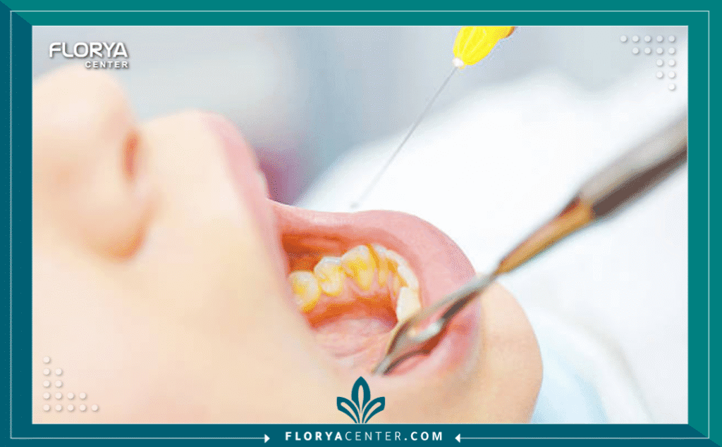 ألم بعد حشو العصب 3 nouralagee93@gmail.com 20250812 113720 ٠٠٠٠ - ألم بعد حشو العصب يُعد ألم بعد حشو العصب (Post-Root Canal Pain) تجربة شائعة، لكن فهم أسبابه هو الخطوة الأولى نحو التعافي الصحيح. في كثير من الأحيان، يكون هذا الألم جزءاً طبيعياً من عملية الشفاء، ولكنه في أحيان أخرى قد يكون مؤشراً على وجود مشكلة تتطلب تدخلاً فورياً. يخضع ملايين الأشخاص لعلاج جذور الأسنان سنوياً لإنقاذ أسنانهم من العدوى والخلع، ومع أن نسبة نجاح الإجراء تتجاوز 90%، إلا أن القلق بشأن ألم بعد حشو العصب يظل الهاجس الأكبر.