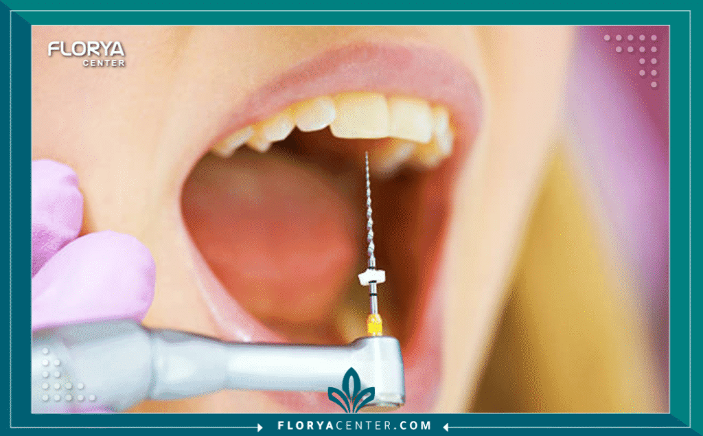 ألم بعد حشو العصب 4 nouralagee93@gmail.com 20250812 113748 ٠٠٠٠ - ألم بعد حشو العصب يُعد ألم بعد حشو العصب (Post-Root Canal Pain) تجربة شائعة، لكن فهم أسبابه هو الخطوة الأولى نحو التعافي الصحيح. في كثير من الأحيان، يكون هذا الألم جزءاً طبيعياً من عملية الشفاء، ولكنه في أحيان أخرى قد يكون مؤشراً على وجود مشكلة تتطلب تدخلاً فورياً. يخضع ملايين الأشخاص لعلاج جذور الأسنان سنوياً لإنقاذ أسنانهم من العدوى والخلع، ومع أن نسبة نجاح الإجراء تتجاوز 90%، إلا أن القلق بشأن ألم بعد حشو العصب يظل الهاجس الأكبر.