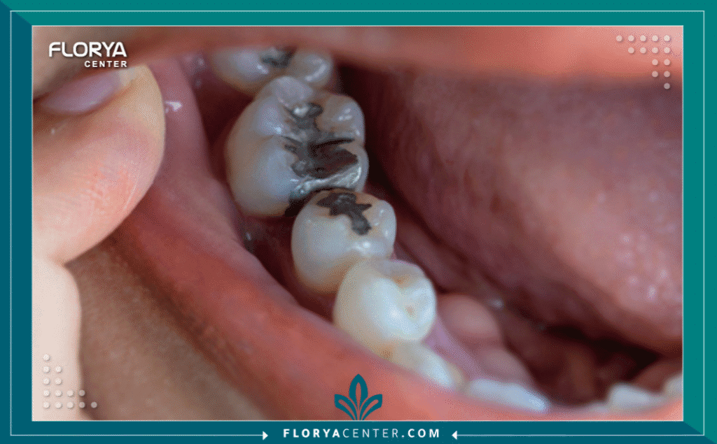 nouralagee93@gmail.com 20250812 193734 ٠٠٠٠ - أنواع حشوات الأسنان يُعد الدليل الشامل لاختيار أفضل أنواع حشوات الأسنان وسد الفراغات خطوتك الأولى نحو استعادة صحة ابتسامتك وجمالها. يُعتبر تسوس الأسنان أحد أكثر المشكلات الصحية شيوعاً في العالم، ويمثل "حشو الأسنان" الإجراء الأساسي والأكثر فعالية لإيقاف هذا التسوس ومنع تفاقمه. مع التقدم الهائل في طب الأسنان الترميمي والتجميلي، لم تعد أنواع حشوات الأسنان (Dental Fillings) تقتصر على وظيفتها العلاجية فحسب، بل أصبحت جزءاً لا يتجزأ من تجميل الابتسامة.