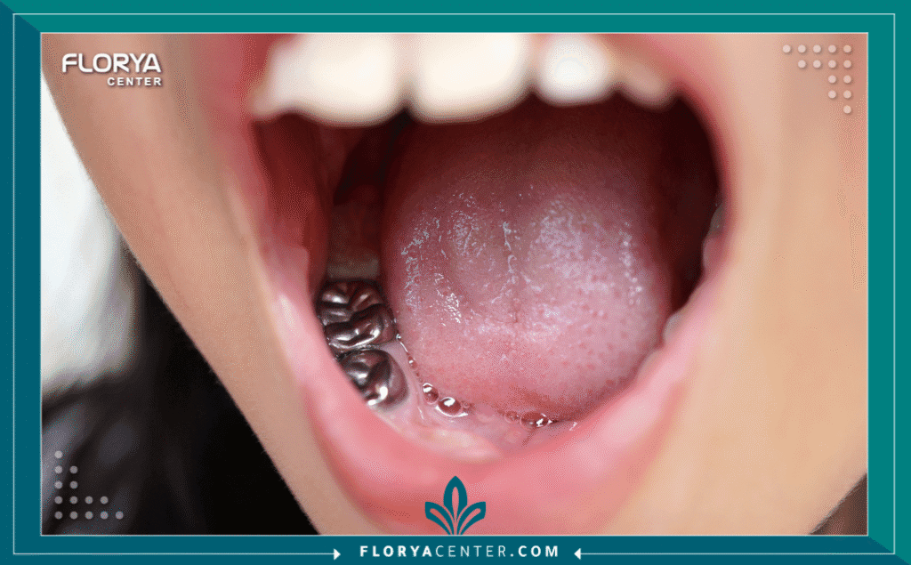 nouralagee93@gmail.com 20250812 193954 ٠٠٠٠ - أنواع حشوات الأسنان يُعد الدليل الشامل لاختيار أفضل أنواع حشوات الأسنان وسد الفراغات خطوتك الأولى نحو استعادة صحة ابتسامتك وجمالها. يُعتبر تسوس الأسنان أحد أكثر المشكلات الصحية شيوعاً في العالم، ويمثل "حشو الأسنان" الإجراء الأساسي والأكثر فعالية لإيقاف هذا التسوس ومنع تفاقمه. مع التقدم الهائل في طب الأسنان الترميمي والتجميلي، لم تعد أنواع حشوات الأسنان (Dental Fillings) تقتصر على وظيفتها العلاجية فحسب، بل أصبحت جزءاً لا يتجزأ من تجميل الابتسامة.