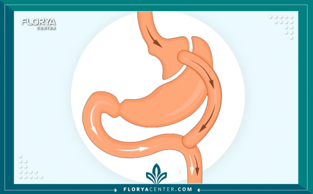 nouralagee93@gmail.com 20250820 141628 ٠٠٠٠ - الفرق بين التكميم وتحويل المسار يمثل فهم الفرق بين التكميم وتحويل المسار (Gastric Sleeve vs. Gastric Bypass) الخطوة الأولى والأكثر أهمية في رحلة علاج السمنة المفرطة. كلا الإجراءين يُعد من أنجح جراحات إنقاص الوزن عالمياً، لكن الاختيار بينهما يعتمد على عوامل فردية دقيقة تشمل الحالة الصحية للمريض، ومؤشر كتلة الجسم (BMI)، وتاريخه مع الأمراض المزمنة كالسكري.