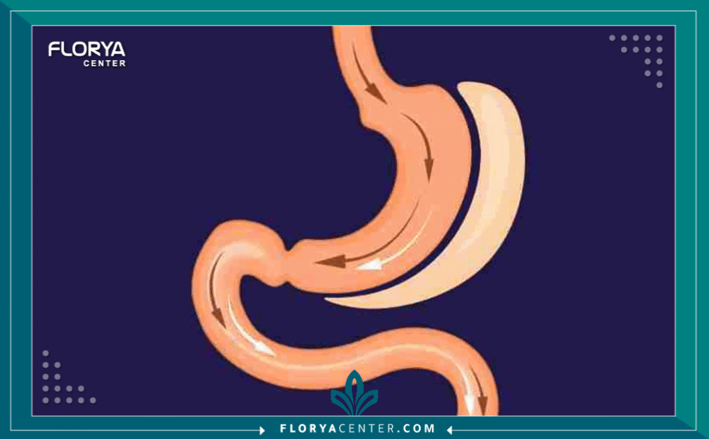 nouralagee93@gmail.com 20250820 141652 ٠٠٠٠ - الفرق بين التكميم وتحويل المسار يمثل فهم الفرق بين التكميم وتحويل المسار (Gastric Sleeve vs. Gastric Bypass) الخطوة الأولى والأكثر أهمية في رحلة علاج السمنة المفرطة. كلا الإجراءين يُعد من أنجح جراحات إنقاص الوزن عالمياً، لكن الاختيار بينهما يعتمد على عوامل فردية دقيقة تشمل الحالة الصحية للمريض، ومؤشر كتلة الجسم (BMI)، وتاريخه مع الأمراض المزمنة كالسكري.