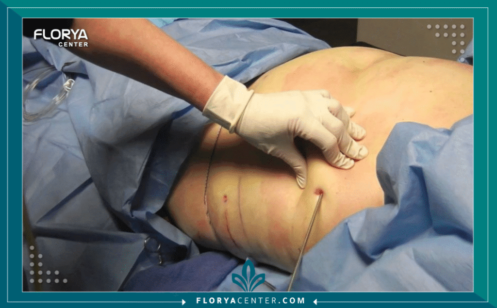 nouralagee93@gmail.com 20250824 120225 ٠٠٠٠ - تكلفة التكميم في السعودية مقابل تركيا هل سئمت من محاولات إنقاص الوزن التقليدية التي تنتهي دائماً بالإحباط؟ هل تنظر إلى المرآة وتتمنى لو كان بإمكانك استعادة صحتك ورشاقتك، لكنك تصطدم بحاجز الأسعار المرتفع؟ إن قرار إجراء عملية قص المعدة هو خطوة مصيرية، ولكن العامل المادي يلعب دوراً محورياً في اتخاذ هذا القرار. هنا تبرز المقارنة الحتمية التي يبحث عنها الآلاف: تكلفة التكميم في السعودية مقابل تركيا. في هذا الدليل الشامل، لن نكتفي بسرد الأرقام، بل سنأخذك في رحلة تحليلية عميقة تكشف لك الفوارق الجوهرية، وتوضح لك لماذا أصبحت تركيا، وتحديداً مركز فلوريا - Floray Center، الوجهة الأولى للراغبين في الجمع بين الجودة الطبية العالمية والسعر الاقتصادي المنافس لعملية تكميم المعدة (Gastric Sleeve).