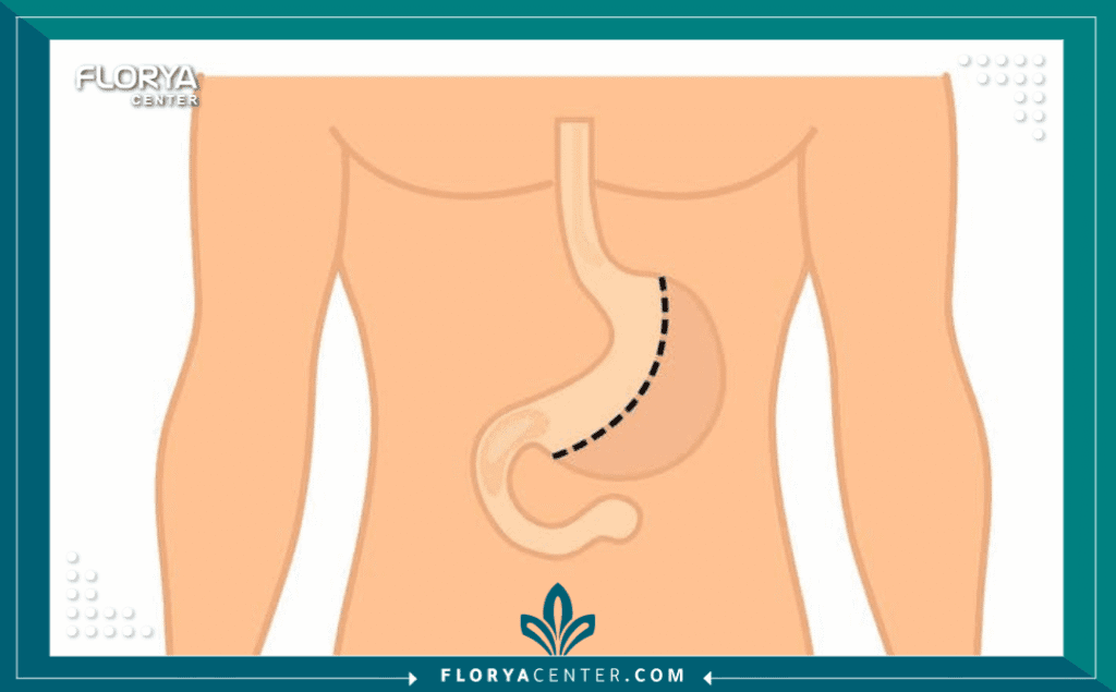 nouralagee93@gmail.com 20250824 120302 ٠٠٠٠ - تكلفة التكميم في السعودية مقابل تركيا هل سئمت من محاولات إنقاص الوزن التقليدية التي تنتهي دائماً بالإحباط؟ هل تنظر إلى المرآة وتتمنى لو كان بإمكانك استعادة صحتك ورشاقتك، لكنك تصطدم بحاجز الأسعار المرتفع؟ إن قرار إجراء عملية قص المعدة هو خطوة مصيرية، ولكن العامل المادي يلعب دوراً محورياً في اتخاذ هذا القرار. هنا تبرز المقارنة الحتمية التي يبحث عنها الآلاف: تكلفة التكميم في السعودية مقابل تركيا. في هذا الدليل الشامل، لن نكتفي بسرد الأرقام، بل سنأخذك في رحلة تحليلية عميقة تكشف لك الفوارق الجوهرية، وتوضح لك لماذا أصبحت تركيا، وتحديداً مركز فلوريا - Floray Center، الوجهة الأولى للراغبين في الجمع بين الجودة الطبية العالمية والسعر الاقتصادي المنافس لعملية تكميم المعدة (Gastric Sleeve).