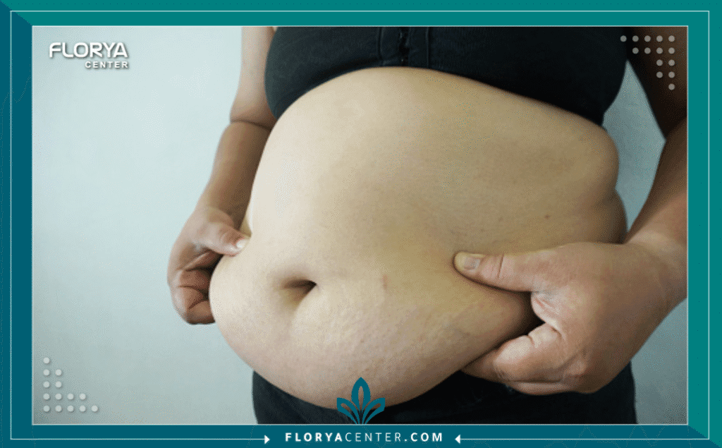 nouralagee93@gmail.com 20250824 120559 ٠٠٠٠ - أيهما أفضل لمرضى السكر التكميم أم تحويل المسار يُعد السؤال عن أيهما أفضل لمرضى السكر التكميم أم تحويل المسار هو الشغل الشاغل للملايين ممن يعانون من السكري من النوع الثاني (Type 2 Diabetes) المرتبط بالسمنة المفرطة. لم تعد جراحات السمنة مجرد وسيلة لإنقاص الوزن، بل تحولت إلى علاج "أيضي" (Metabolic Surgery) فعال قادر على تحقيق الشفاء التام (Remission) في كثير من الحالات. عند المقارنة بين تكميم المعدة (Sleeve Gastrectomy) وتحويل المسار (Gastric Bypass)، نجد أن لكل منهما آلية عمل مختلفة تؤثر على مستويات السكر في الدم.