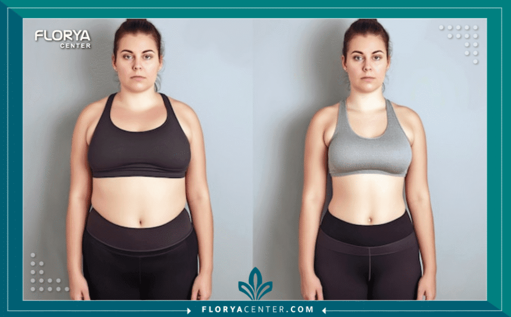 nouralagee93@gmail.com 20250830 143437 ٠٠٠٠ - عروض عمليات السمنة في تركيا هل سئمت من محاولات الحمية التي لا تنتهي؟ هل تشعر أن وزنك يقف حاجزاً بينك وبين الحياة التي تستحقها؟ إن البحث عن عروض عمليات السمنة في تركيا (Obesity Surgery Offers in Turkey) ليس مجرد بحث عن سعر أقل، بل هو بحث عن بوابة جديدة للأمل، للصحة، وللثقة بالنفس. في عام 2025، تحولت تركيا إلى العاصمة العالمية للطب التجميلي والعلاجي، حيث يجتمع الخبراء العالميون مع التقنيات الثورية لتقديم حلول جذرية للسمنة المفرطة. في هذا المقال الموسوعي، سنكشف لك كل ما يخفيه عالم صفقات عمليات السمنة في تركيا، لنكون بوصلتك الآمنة قبل اتخاذ قرار قد يغير مسار حياتك للأبد.