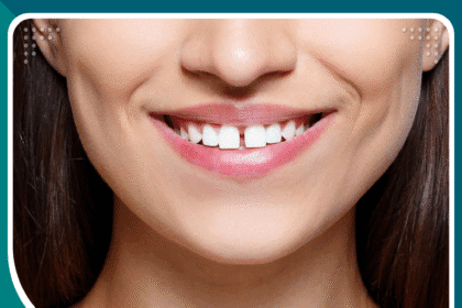 تجميل الأسنان المتفرقة