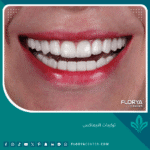 تركيبات الايماكس