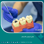 علاج تسوس الأسنان