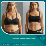 عمليات السمنة للمقيمين بالسعودية
