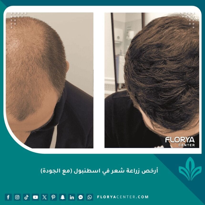 أرخص زراعة شعر في اسطنبول (مع الجودة)
