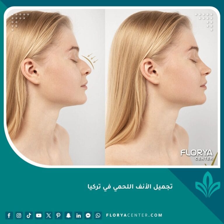 تجميل الأنف اللحمي في تركيا