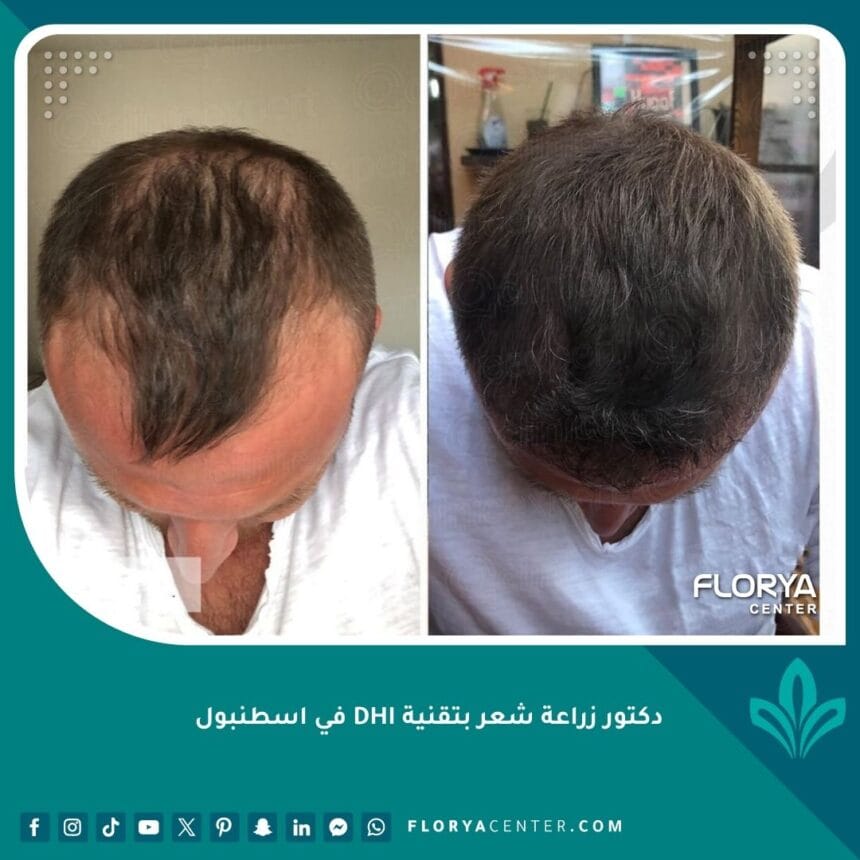 دكتور زراعة شعر بتقنية DHI في اسطنبول