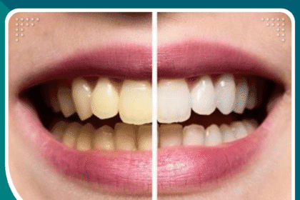 مركز تبييض الأسنان في اسطنبول