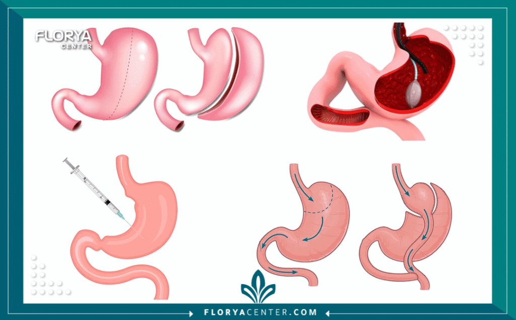 جراحة السمنة في تركيا 4 نسخة من Hayaalaje12 20250903 154408 ٠٠٠٠ - جراحة السمنة في تركيا هل تشعر بأن وزنك الزائد قد أصبح سجنًا يمنعك من الاستمتاع بتفاصيل الحياة اليومية التي يعيشها الآخرون ببساطة؟ إن جراحة السمنة في تركيا (Obesity Surgery) ليست مجرد إجراء طبي لإنقاص الوزن، بل هي "نقطة التحول" الفاصلة التي تمنحك فرصة ثانية لامتلاك جسد صحي، نشيط، ومفعم بالحيوية بعيدًا عن شبح الأمراض المزمنة. في السنوات الأخيرة، لم تعد هذه العمليات رفاهية، بل أصبحت الحل الجذري والآمن لملايين الأشخاص الذين خذلتهم الحميات التقليدية.