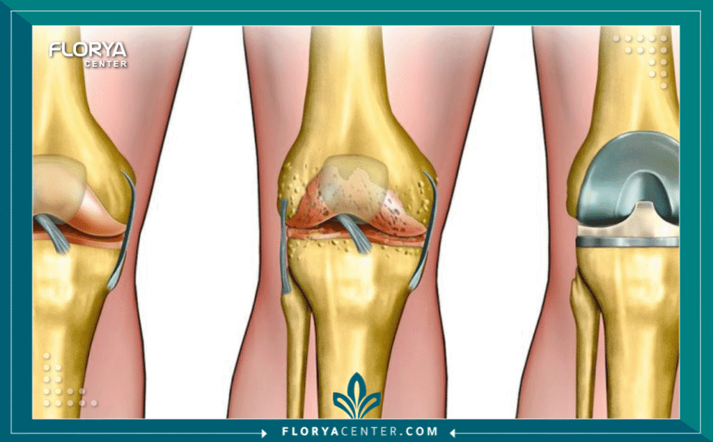 استبدال مفصل الورك والركبة 3 نسخة من Hayaalaje12 20250904 145851 ٠٠٠٠ - استبدال مفصل الورك والركبة تُعد جراحة استبدال مفصل الورك والركبة (Hip and Knee Arthroplasty) واحدة من أكثر الإجراءات الجراحية نجاحاً وفعالية في الطب الحديث، حيث تمثل طوق نجاة لملايين المرضى حول العالم الذين يعانون من آلام مبرحة تعيق ممارستهم للحياة الطبيعية. إن تآكل المفاصل لا يؤثر فقط على القدرة الجسدية للحركة، بل يمتد تأثيره ليشمل الصحة النفسية والاجتماعية للمريض، مما يجعل البحث عن حل جذري أمراً حتمياً. تهدف عملية استبدال مفصل الورك إلى إزالة الأجزاء التالفة من المفصل واستبدالها بأجزاء صناعية متطورة تحاكي الحركة الطبيعية بدقة متناهية.
