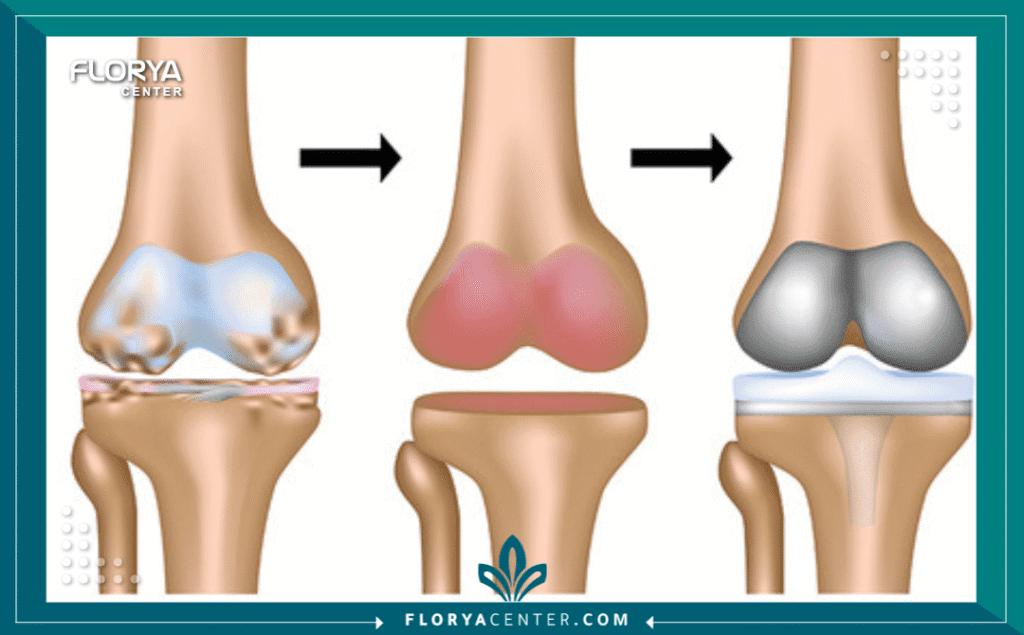استبدال مفصل الورك والركبة 4 نسخة من Hayaalaje12 20250904 145916 ٠٠٠٠ - استبدال مفصل الورك والركبة تُعد جراحة استبدال مفصل الورك والركبة (Hip and Knee Arthroplasty) واحدة من أكثر الإجراءات الجراحية نجاحاً وفعالية في الطب الحديث، حيث تمثل طوق نجاة لملايين المرضى حول العالم الذين يعانون من آلام مبرحة تعيق ممارستهم للحياة الطبيعية. إن تآكل المفاصل لا يؤثر فقط على القدرة الجسدية للحركة، بل يمتد تأثيره ليشمل الصحة النفسية والاجتماعية للمريض، مما يجعل البحث عن حل جذري أمراً حتمياً. تهدف عملية استبدال مفصل الورك إلى إزالة الأجزاء التالفة من المفصل واستبدالها بأجزاء صناعية متطورة تحاكي الحركة الطبيعية بدقة متناهية.